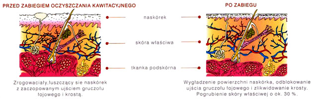 Peeling kawitacyjny - efekty działania
